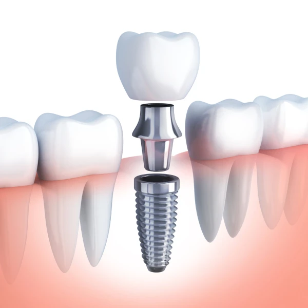 Dental Implant Marketing